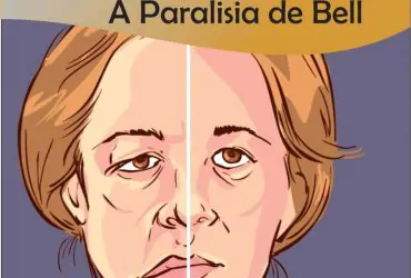 Paralisia de Bell
