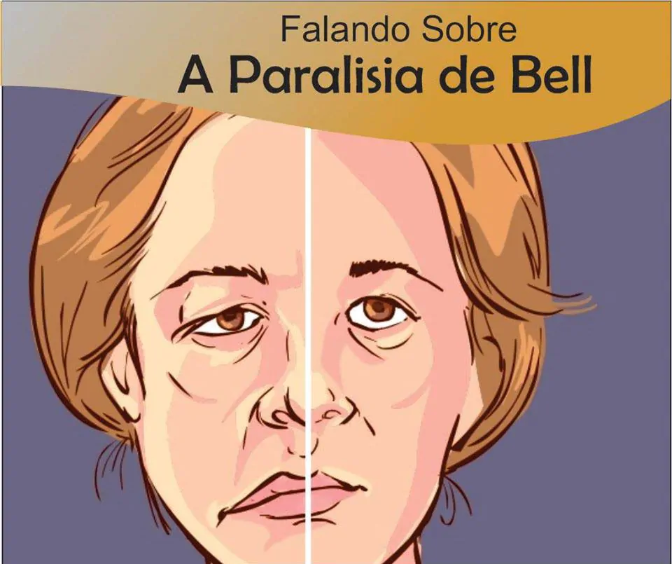 Paralisia de Bell